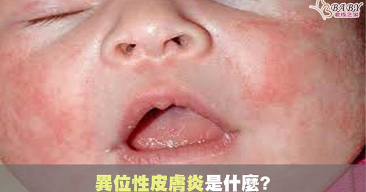 寶寶異位性皮膚炎是什麼?症狀有哪些?北投之家分享嬰兒止癢小技巧